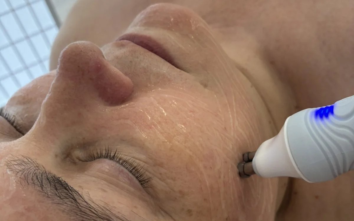Hidrodermabráziós arckezelés (aqua peeling) Kecskeméten: a mély tisztítás, ami hidratál is